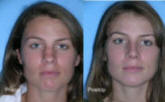 Juvederm Los Angeles